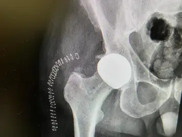 Radiografía de una de las prótesis en las que se aprecia la cabeza cerámica Radiografía de una de las prótesis en las que se aprecia la cabeza cerámica