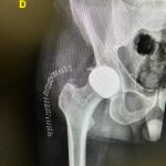 Radiograf&iacute;a de una de las pr&oacute;tesis en las que se aprecia la cabeza cer&aacute;mica