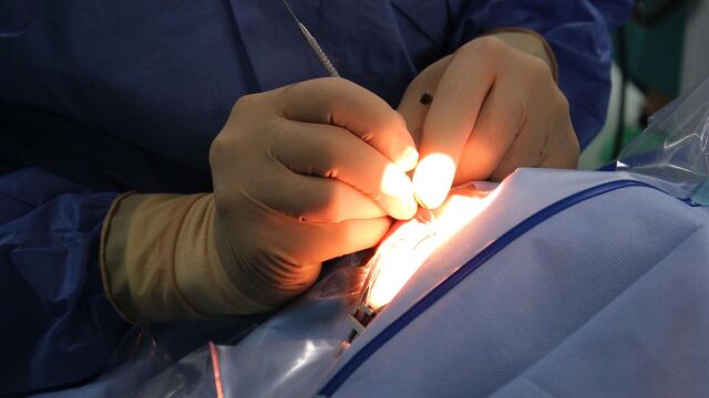 Usar radioterapia en vez de cirug&iacute;a puede reducir el linfedema en c&aacute;ncer de mama, seg&uacute;n un estudio