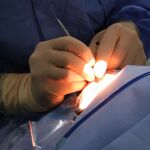 Usar radioterapia en vez de cirug&iacute;a puede reducir el linfedema en c&aacute;ncer de mama, seg&uacute;n un estudio