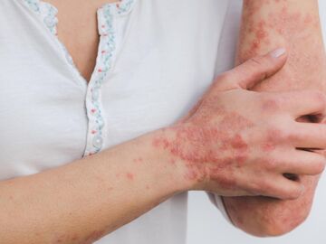 esiones cut&aacute;neas caracter&iacute;sticas de la psoriasis, una enfermedad inflamatoria cr&oacute;nica de la piel relacionada con la activaci&oacute;n excesiva del sistema inmunitario 