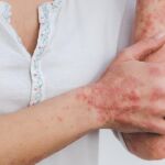esiones cut&aacute;neas caracter&iacute;sticas de la psoriasis, una enfermedad inflamatoria cr&oacute;nica de la piel relacionada con la activaci&oacute;n excesiva del sistema inmunitario 
