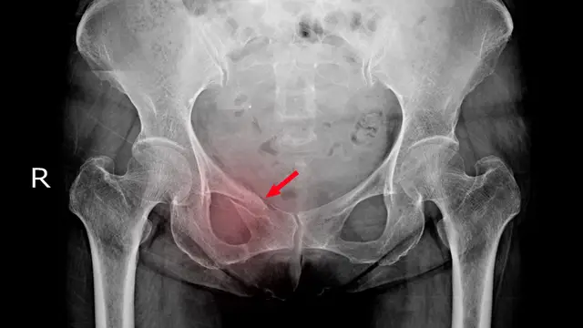 La osteoporosis es una patología que hace que los huesos se vuelvan más frágiles La osteoporosis es una patología que hace que los huesos se vuelvan más frágiles