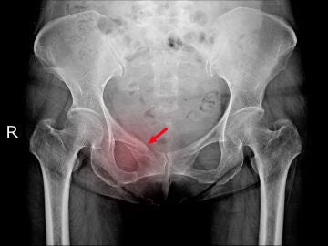 La osteoporosis es una patolog&iacute;a que hace que los huesos se vuelvan m&aacute;s fr&aacute;giles