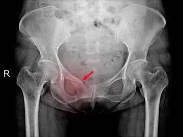 La osteoporosis es una patología que hace que los huesos se vuelvan más frágiles La osteoporosis es una patología que hace que los huesos se vuelvan más frágiles