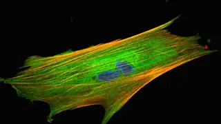 Imagen de fibroblasto asociado al cáncer. Imagen de fibroblasto asociado al cáncer.
