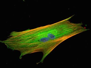 Imagen de fibroblasto asociado al c&aacute;ncer.