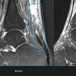 Tend&oacute;n de Aquiles regenerado