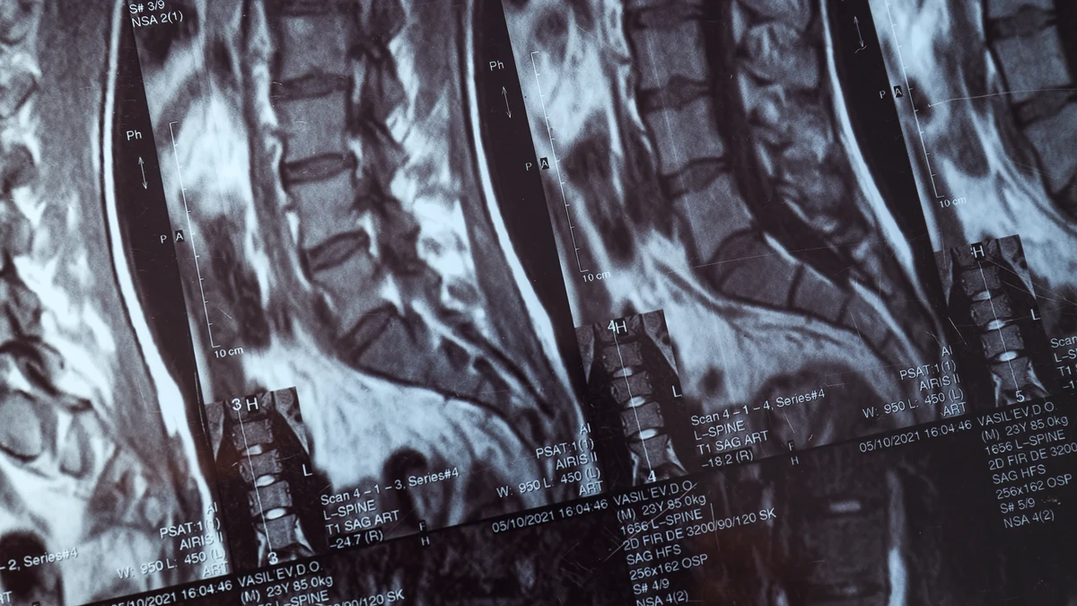 TAC lumbar