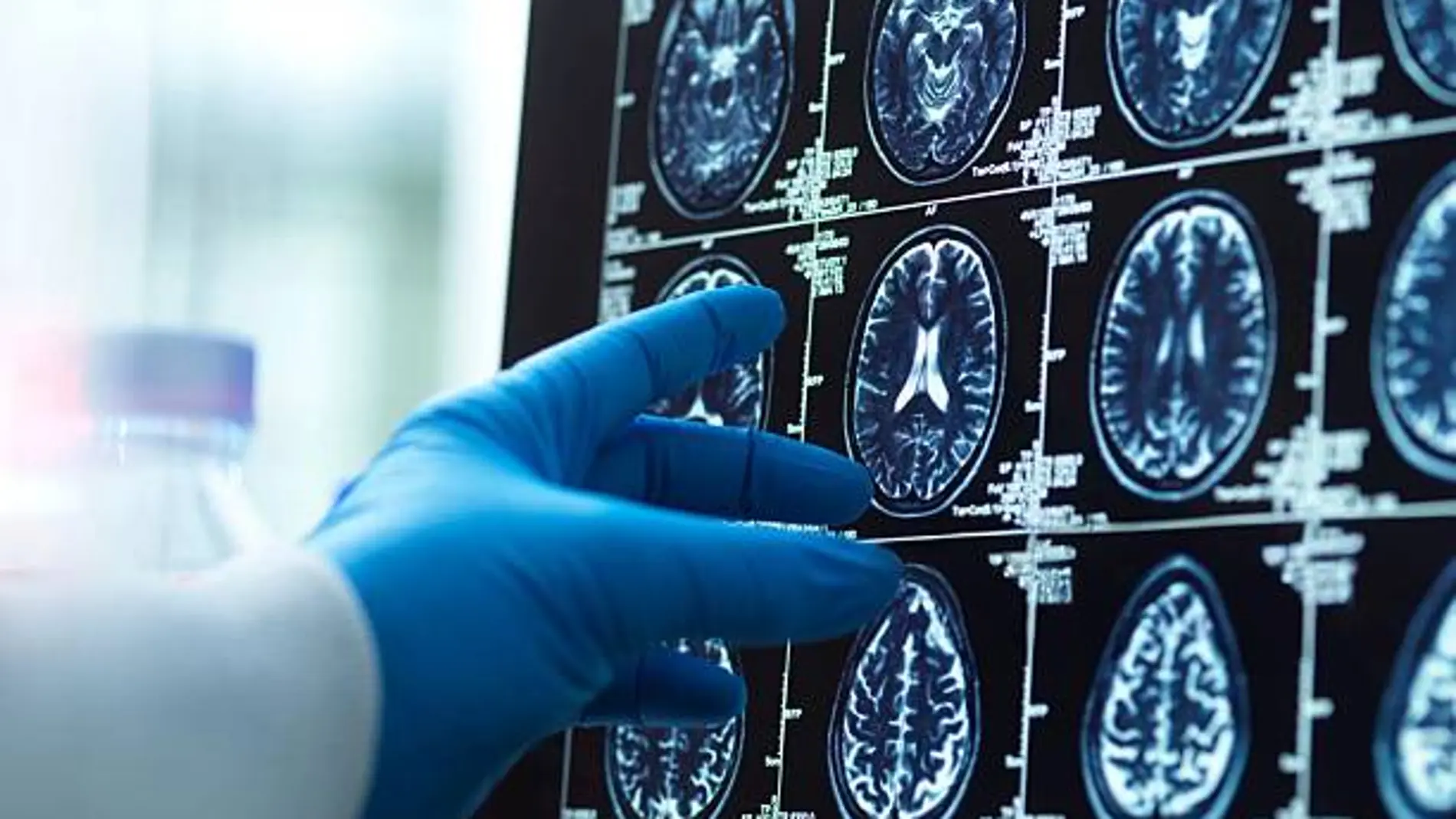 Crean una nueva prueba genética para detectar el cáncer cerebral que permite obtener un diagnóstico en menos de dos horas Crean una nueva prueba genética para detectar el cáncer cerebral que permite obtener un diagnóstico en menos de dos horas