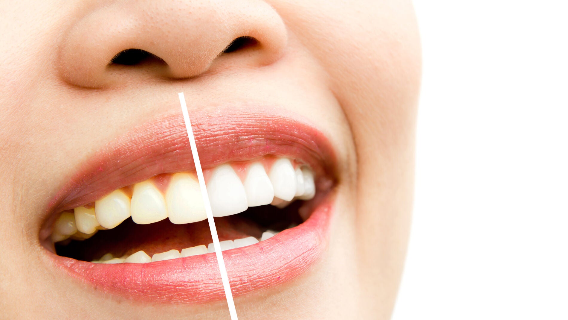 Blanqueador dental retirado por exceso de peróxido de hidrógeno